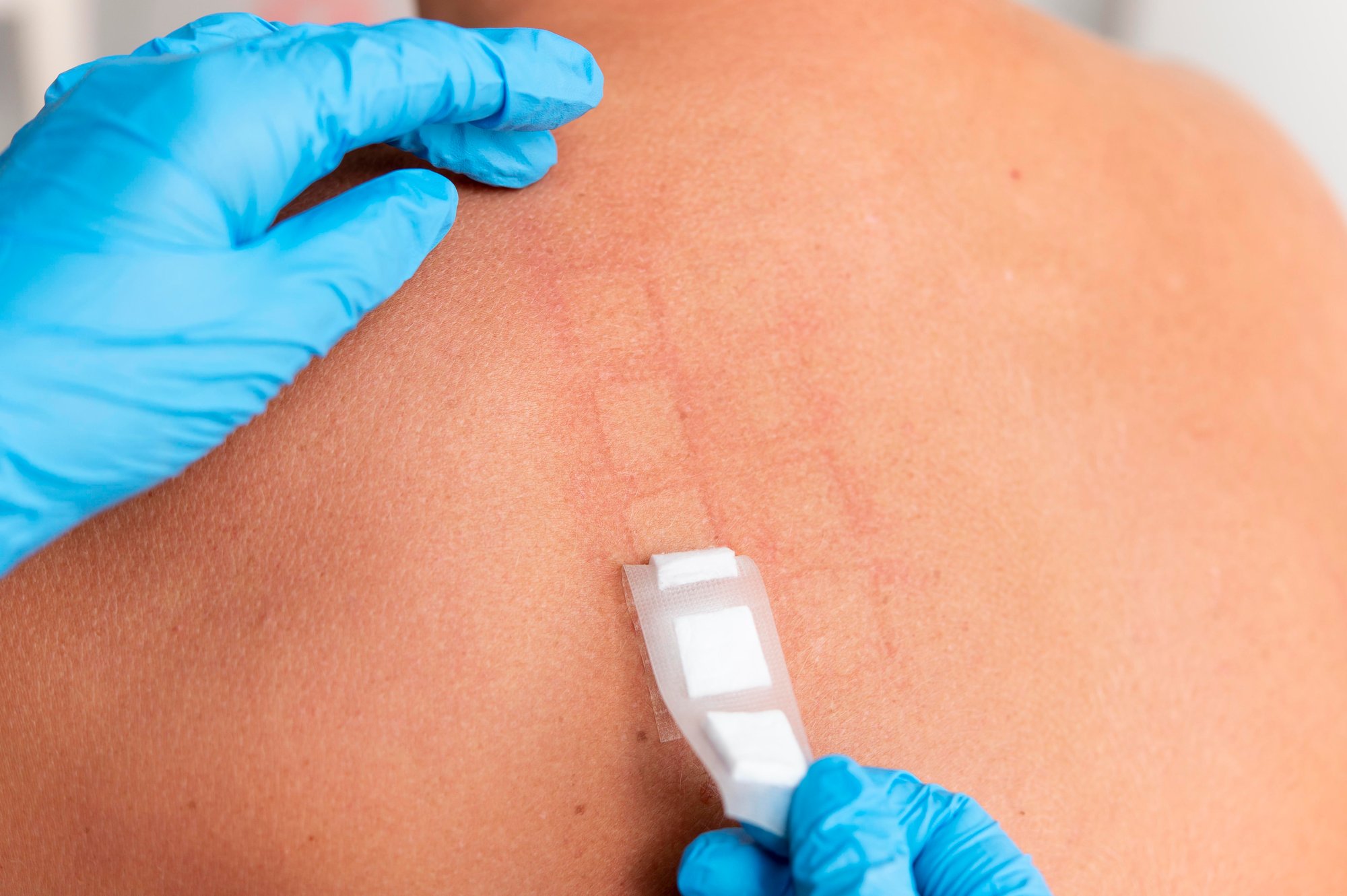 skin-allergy-reaction-person-s-back (1)